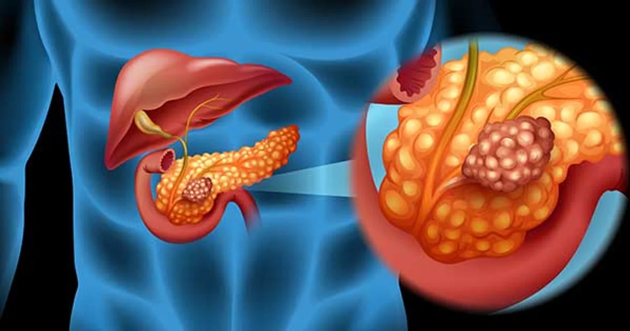 C&aacute;ncer de p&aacute;ncreas: cient&iacute;ficos espa&ntilde;oles lograron eliminarlo en un estudio con ratones