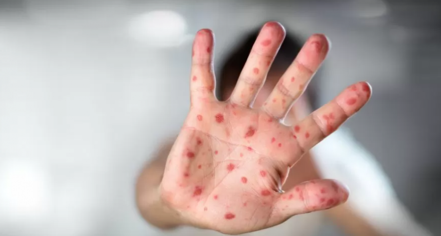 El Ministerio de Salud confirm&oacute; el primer caso sospechoso de viruela del mono en la Argentina